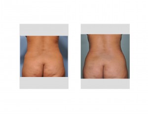 liposuction-after-tummy-tuck-back-view-dr-barry-eppley-indianapolis