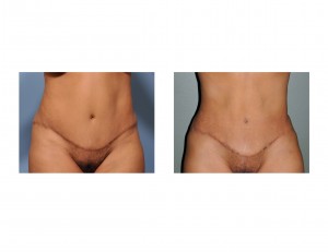 liposuction-after-tummy-tuck-front-view-dr-barry-eppley-indianapolis