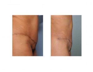 liposuction-after-tummy-tuck-side-view-dr-barry-eppley-indianapolis