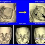 orbital-facial-aging-dr-barry-eppley-indianapolis