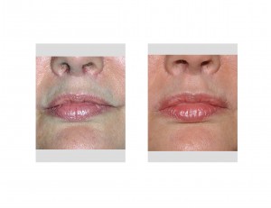 philtral-enhancement-upper-lip-front-view-dr-barry-eppley-indianapolis