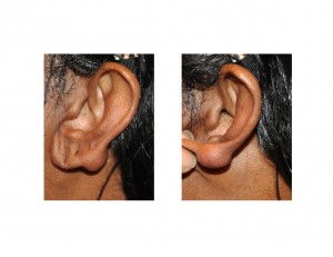 ear-keloid-dr-barry-eppley-indianapolis