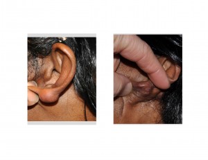 ear-keloid-repair-results-back-view-dr-barry-eppley-indianapolis