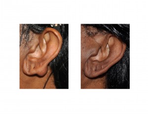 ear-keloid-repair-results-front-view-dr-barry-eppley-indianapolis