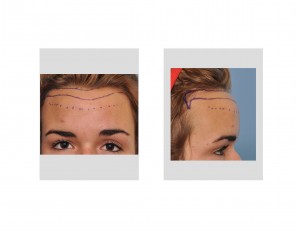 hairline-lower-forehead-reduction-surgical-plan-dr-barry-eppley-indianapolis