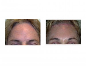 hairline-pretrichial-browlift-dr-barry-eppley-indianapolis