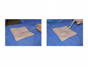 injectable-kryptonite-sternoplasty-dr-barry-eppley-indianapolis