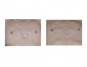 injectable-sternoplasty-immediate-result-front-view