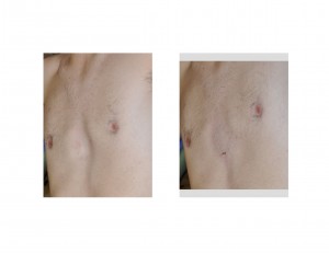 injectable-sternoplasty-immediate-result-left-side-view1