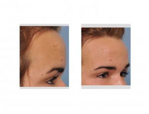 long-forehead-with-frontal-bulge-dr-barry-eppley-indianapolis