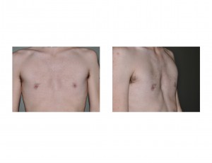 minor-pectus-excavatum-chest-deformity-dr-barry-eppley-indianapolis