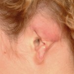 partial-ear-amputation-dr-barry-eppley-indianapolis