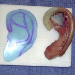 rib-graft-ear-reconstruction-dr-barry-eppley-indianapolis