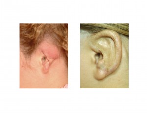 rib-graft-ear-reconstruction-dr-barry-eppley-plastic-surgeon