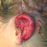 temporoparietal-flap-coverage-of-rib-graft-ear-reconstruction-dr-barry-eppley-indianapolis