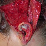 temporoparietal-flap-in-ear-reconstruction-dr-barry-eppley-indianapolis