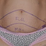 mini-vs-full-tummy-tuck-dr-barry-eppley-indianapolis