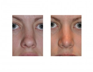 rhinoplasty-for-the-crooked-nose-dr-barry-eppley-indianapolis