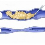 sclerotherapy-injections-dr-barry-eppley-indianapolis