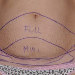 tummy-tuck-types-dr-barry-eppley-indianapolis