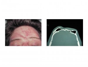 frontal-contour-defect-dr-barry-eppley1