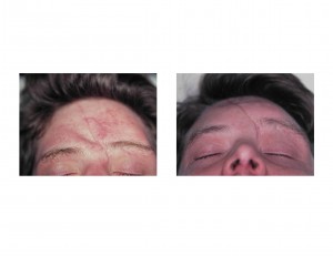 frontal-cranioplasty-dr-barry-eppley-indianapolis