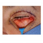 herniated-eyelid-fat-removal-in-male-lower-blepharoplasty-dr-barry-eppley-indianapolis