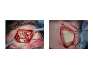 hydroxyapatite-cranioplasty-reconstruction-dr-barry-eppley-indianapolis