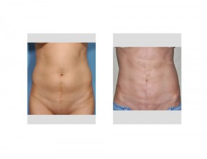vertical-tummy-tuck-results-front-view-dr-barry-eppley-indianapolis