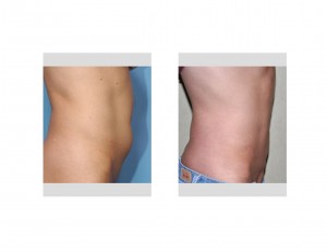vertical-tummy-tuck-results-side-view-dr-barry-eppley-indianapolis