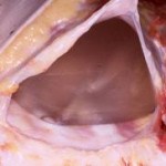 breast-implant-capsule-dr-barry-eppley-indianapolis