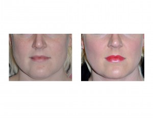 facial-sculpting-by-liposuction-dr-barry-eppley-indianapolis