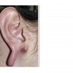 gauged-and-torn-ear-deformity-dr-barry-eppley-indianapolis