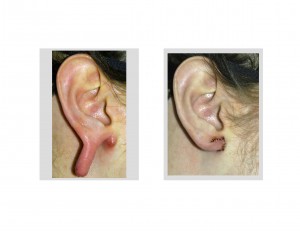 gauged-earlobe-flap-repair-dr-barry-eppley-indianapolis
