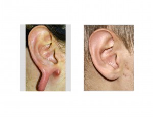 gauged-earlobe-reconstruction-dr-barry-eppley-indianapolis
