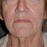injectable-fillers-in-older-nasolabial-folds-after-dr-barry-eppley-indianapolis