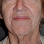 injectable-fillers-in-the-older-patient-nasolabial-fold-before-dr-barry-eppley-indianapolis
