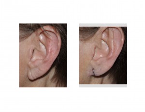 left-earlobe-rejuvenation-by-reduction-dr-barry-eppley-indianapolis