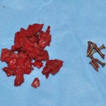 medpor-chin-implant-removal-dr-barry-eppley-indianapolis