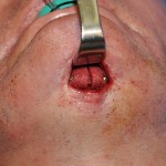 medpor-chin-implant-replacement-dr-barry-eppley-indianapolis