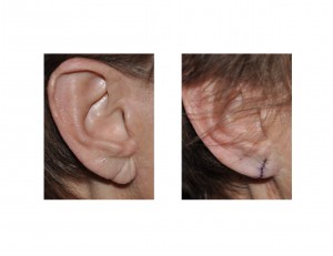 right-earlobe-rejuvenation-by-reduction-dr-barry-eppley-indianapolis