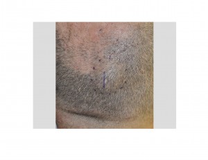 skull-bumo-osteoma-incision-dr-barry-eppley-indianapolis