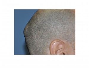 skull-bump-osteoma-dr-barry-eppley-indianapolis