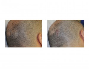 skull-bump-osteoma-removal-dr-barry-eppley-indianapolis