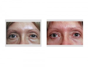 blepharoplasty-eyelid-bag-removal-indianapolis-dr-barry-eppley