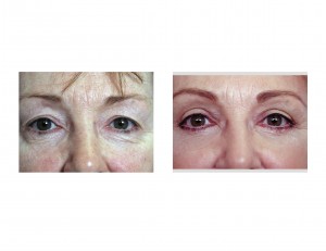 blepharoplasty-eyelid-tucks-indianapolis-dr-barry-eppley