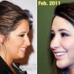 bristol-palin-jaw-and-chin-surgery-dr-barry-eppley-indianapolis