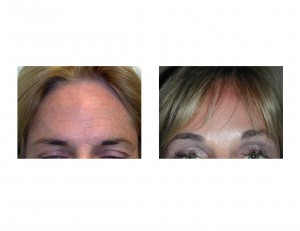 browlift-with-fat-injections-dr-barry-eppley-indianapolis