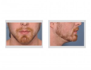 chin-and-jaw-angle-deficiency-dr-barry-eppley-indianapolis