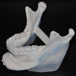 custom-jaw-angle-implants-dr-barry-eppley-indianapolis